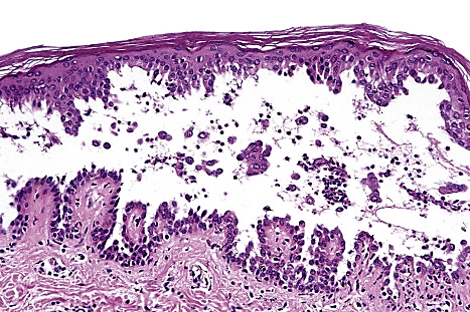 <p>TYPE 2 HYPERSENSITIVITY</p><p>antigens are desmogliens between epidermal cells; causes skin vesicles</p>