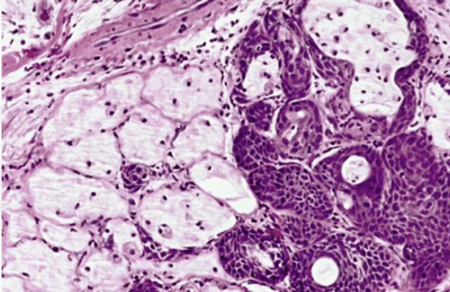 <p>These histologic characteristics are indicative of what oral pathology?</p><p>-Pseudoepitheliomatous Hyperplasia</p><p>-Sialometaplasia</p><p>-Coagulative necrosis of the adjacent glands</p>