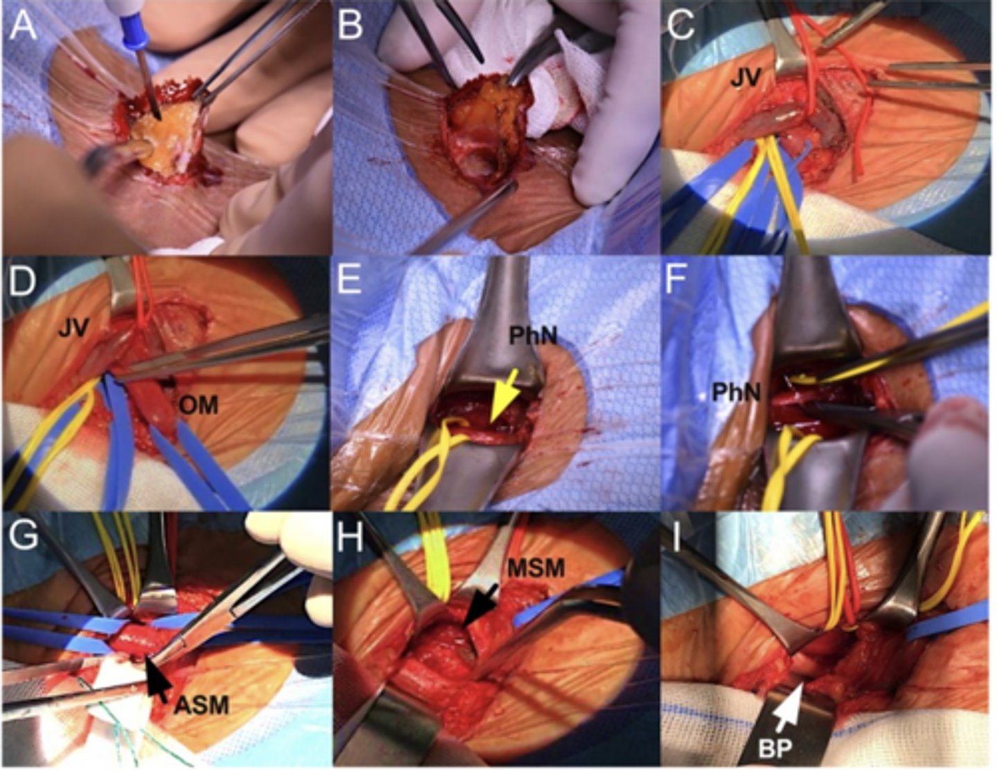 <p>Cervical rib resection, anterior or middle scalenectomy, and neurolysis (C7, C8, or T1).</p>