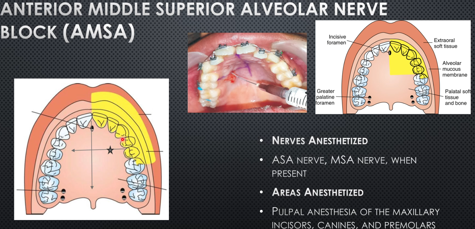 <ul><li><p>Area anesthetized: palatal mucosa and bone of the pre-maxilla + behind premolars and MB cusp or 1st molar</p></li><li><p>Procedure: Insert less than half way between bisecting line of incisive papilla and premolars; use whole cartridge over 2 min</p></li><li><p>Onset of action:3-5min</p></li><li><p>Complications: ulcer that lasts 2 days</p></li><li><p>When is it useful: Cosmetic Procedures where lip must not be anesthetized</p></li><li><p>Amount of anesthetic:1.4-1.8ml</p></li></ul><p></p>