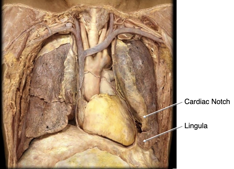 <p>we can take sample from pericardial space or directly access heart through cardiac notch (without damaging lung or pleural space)</p>