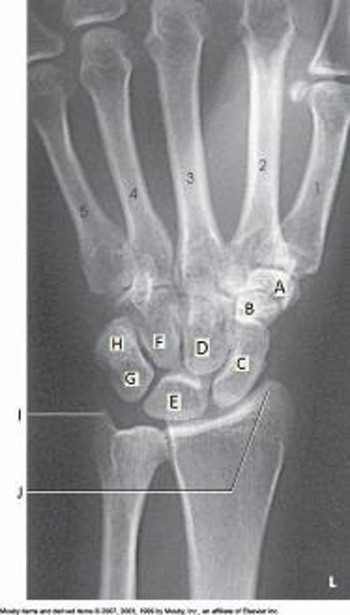 <p>Which bone is labeled as letter E in the figure above?</p><p>Capitate</p><p>Scaphoid</p><p>Triquetrum</p><p>Lunate</p>