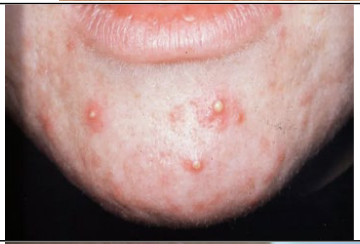 <span style="color: rgb(5, 2, 2);"><span>What kind of skin condition is this?</span></span>