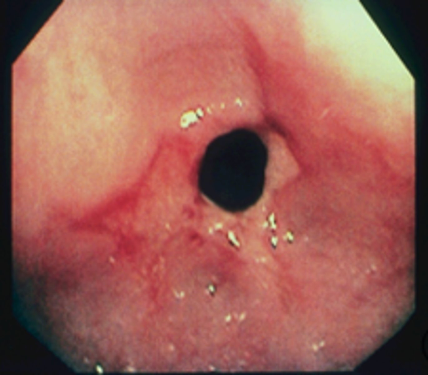 <p>patient presents with dysphagia to solid foods. An endoscopy is performed and a narrowing of the esophogeal wall is noticed as well as signs of GERD. What is the diagnosis?</p>