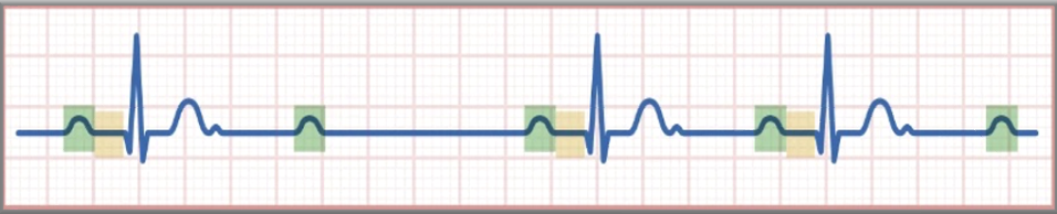 <ul><li><p class=""><strong>PR Interval</strong>: Fixed. </p></li><li><p class=""><strong>PP Interval</strong>: Fixed.</p></li><li><p class=""><strong>Occasional P wave</strong> not followed by QRS.</p></li><li><p class="">Essentially, the PR interval is constant, and then the QRS is dropped.</p></li><li><p class="">Typically unstable and needs treatment.</p></li></ul><p class=""><strong>Treatment</strong>: Atropine or pacing.</p>