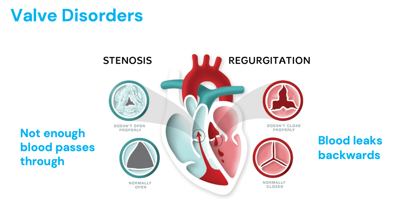 <ul><li><p><strong>Stenosis</strong> - not enough blood passes through, hardened, narrowed artery (hypertrophy, afterload increases)</p></li><li><p><strong>Regurgitation</strong> - blood leaks backwards&nbsp;(RV lowest pressure, high to low, preload high and EDV)</p></li><li><p>AV valves - mitral and tricuspid (“tri” to be right)</p><ul><li><p>Tricuspid = prone to damage from IV drug use&nbsp;</p></li></ul></li><li><p>Semilunar valves - aortic and pulmonary</p></li><li><p>Murmur during systole (ventricular contraction) = aortic/pulmonic stenosis, mitral/tricuspid regurgitation</p></li><li><p>Murmur during diastole (ventricular relaxation) = aortic/pulmonic regurgitation, mitral/tricuspid stenosis</p></li></ul><p></p>