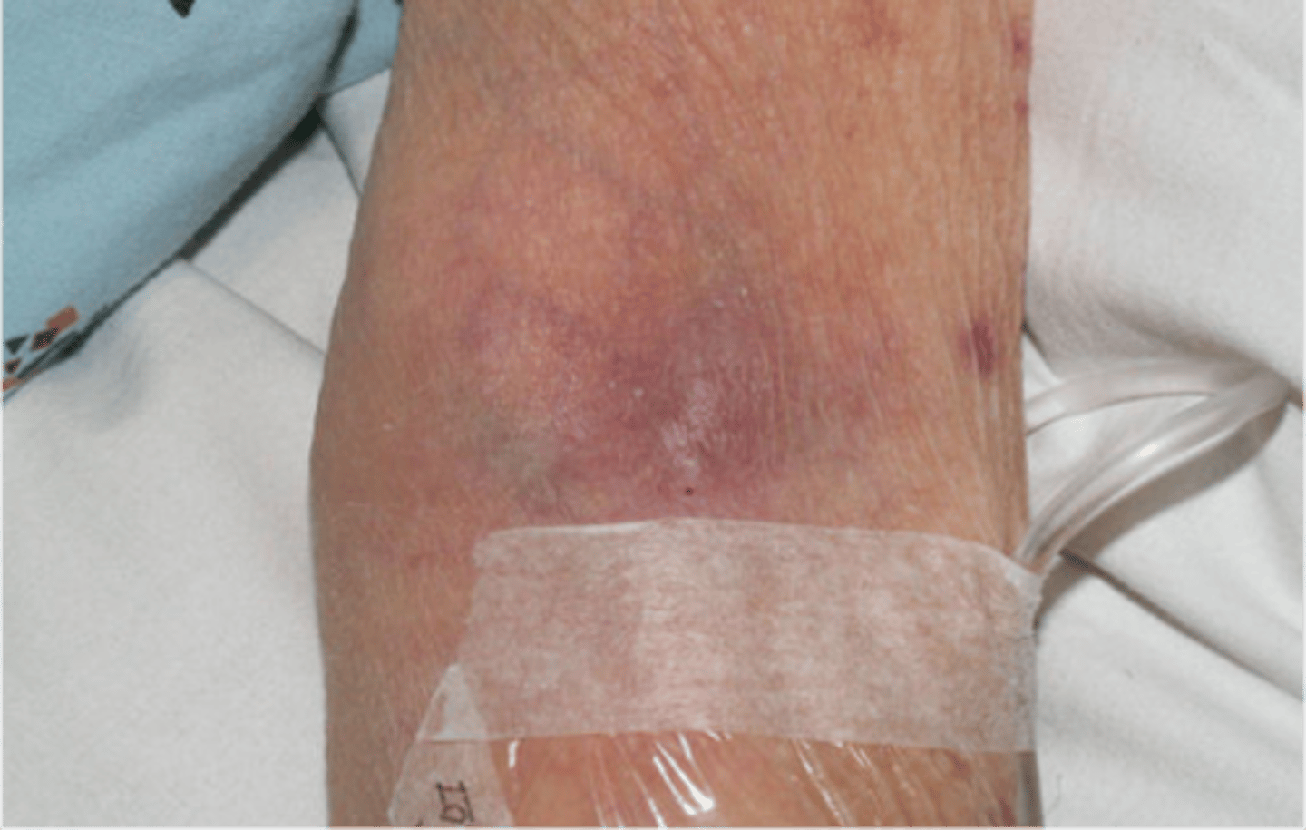 <p>Inflammation of a vein</p><p>Presents as redness above IV site and flushing is painful</p>