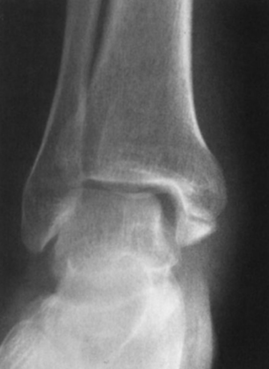 <p>You examine the radiographs for Case 6-4. Only the</p><p>AP view is shown here (Figure 6-11). You tell the pa-</p><p>tient he has broken his ankle, but you want to get one</p><p>more study:</p><p>A. Entire tibia and fibula, to exclude more proximal</p><p>fractures</p><p>B. Ipsilateral foot, to exclude a fracture of the fifth</p><p>metatarsal</p><p>C. Contralateral ankle, for comparison purposes</p><p>D. CT, for precise evaluation of the alignment of the</p><p>fracture</p>