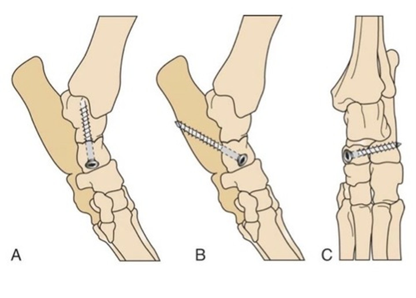 <p>What is happening here, where a lag screw is placed from head of talus into trochlea of talus AND from caudal medial base of talus into calcaneus?</p>