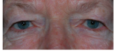 <p>dermatochalasis simulates ptosis</p><p></p><p>symmetrical</p><p>measure MRD if pt really has ptosis</p>