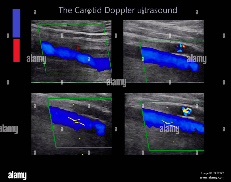 <p>the direction of this common carotid artery blood flow is</p>