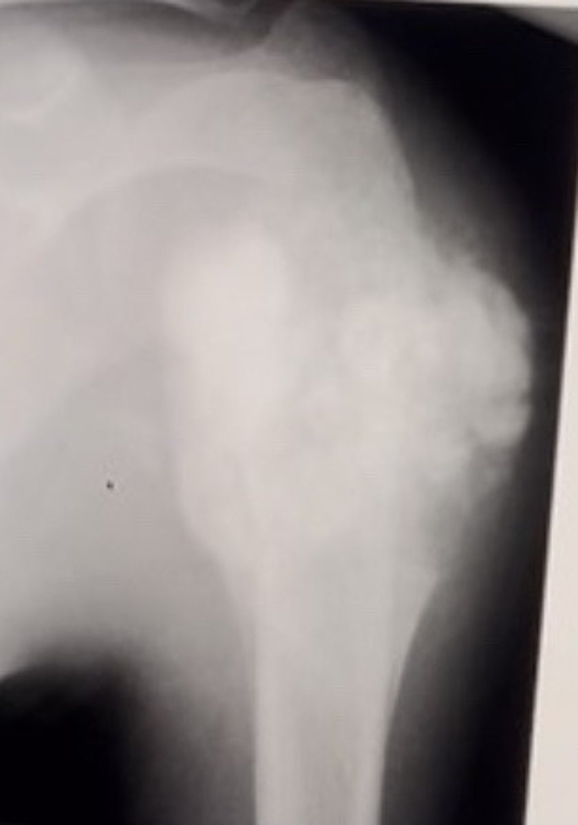 <p>13 year old male with shoulder pain.</p><p>Please describe the lesion above with appropriate answer options.</p><p>Select 4 correct answers</p>