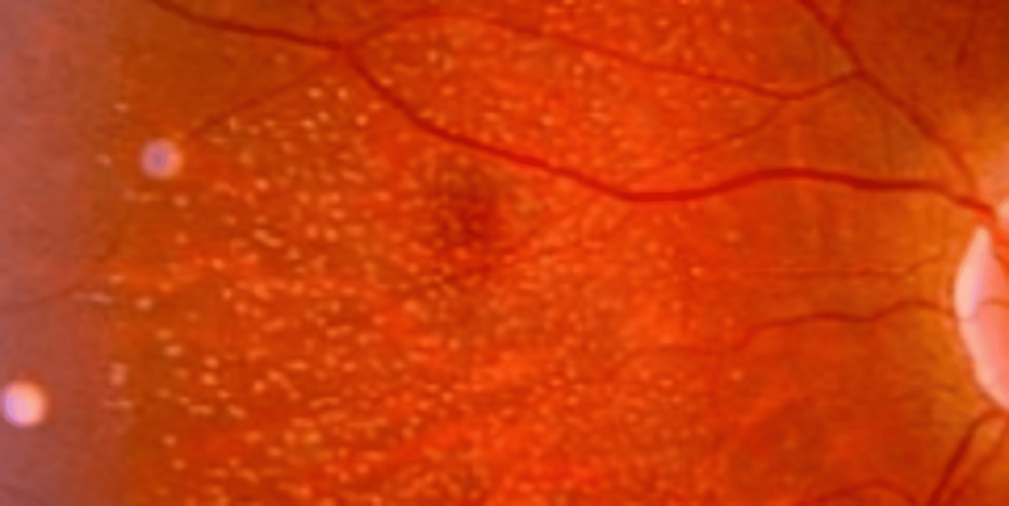 <p>autosomal recessive congenital stationary night blindness having tiny yellow spots at the posterior pole that spares the fovea.</p>