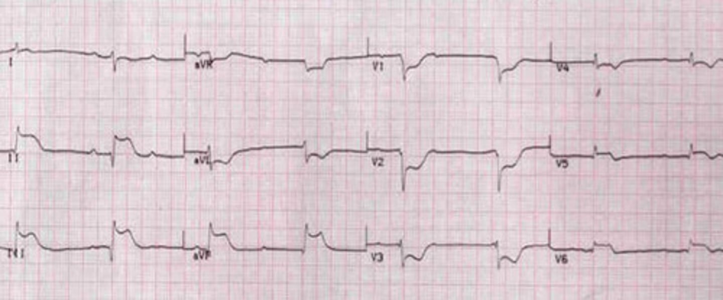 <p>Inferior-lateral STEMI</p>