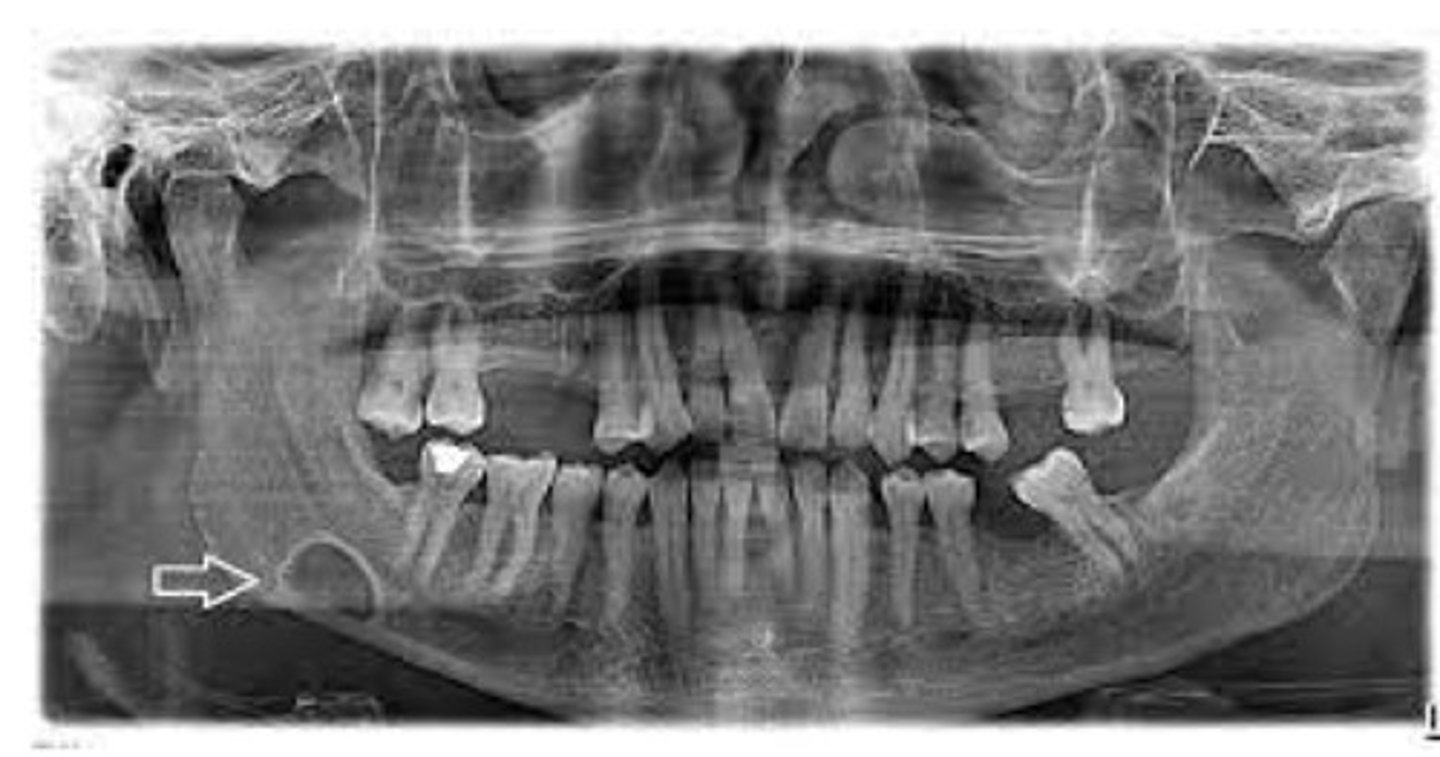 <p>-A pseudocyst</p><p>-Not a pathologic cavity</p><p>Clinically: An anatomic depression on the posterior lingual area of the mandible</p><p>Treatment: None</p><p>Lined with thickened bone which makes it look radiopaque</p>
