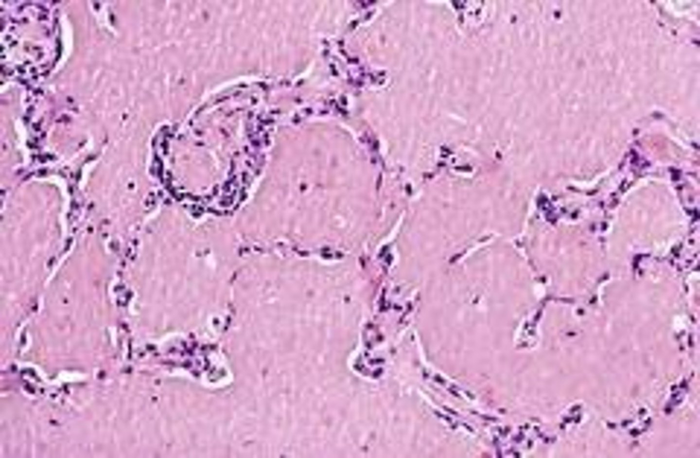 <p>abnormally thick mucus filled lungs, intestines, and pancreas</p>