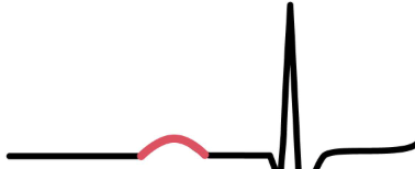 <p>atrial depolarization</p>