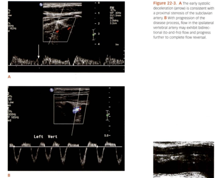 <p>Both of these indicate what of the subclavian artery? Is it a complete steal or not?</p>