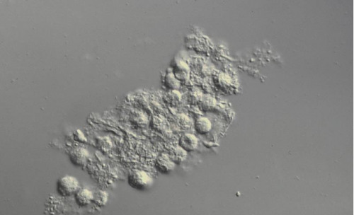 This casts is Bacilli within and bound to the protein matrix; may be pure bacterial cast or mixed with RBC
