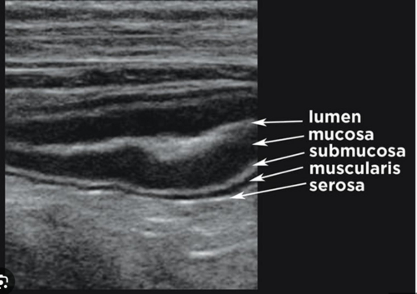 <p>Echogenic - Bright</p>
