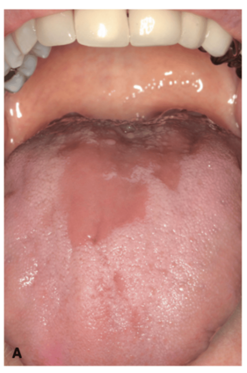 <p>localized loss of the filiform papillae creating a smooth, red, rhomboid-shape at the midline on the dorsal surface of tongue </p><p>more common in ADULTS </p>