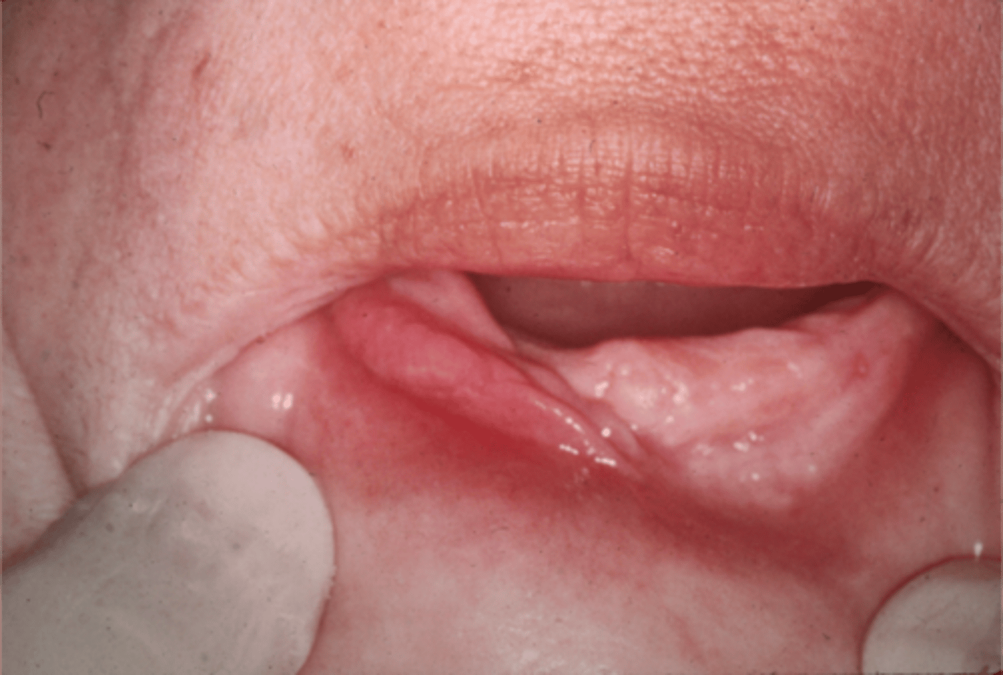 <p>inflammatory fibrous hyperplasia</p>