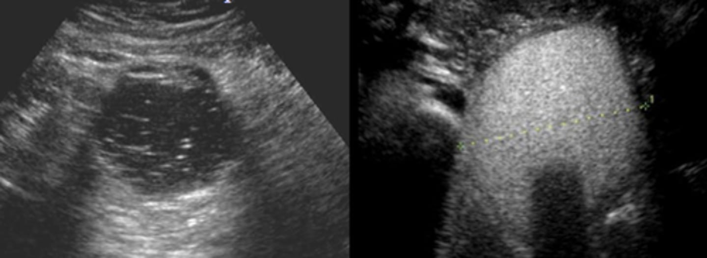 <p>US findings of malignant thyroid nodules</p>