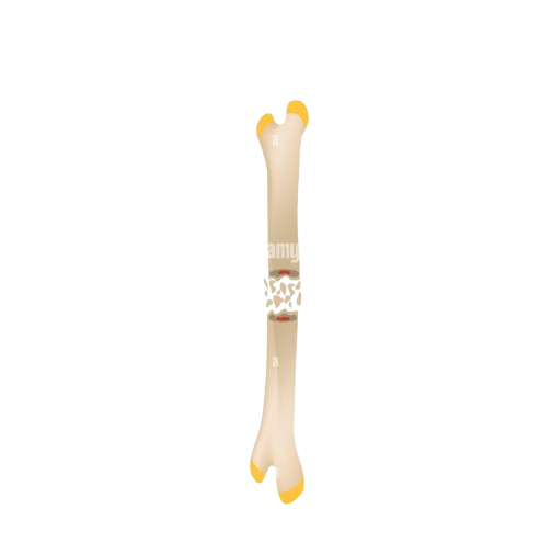 <p>What type of fracture is this? </p>