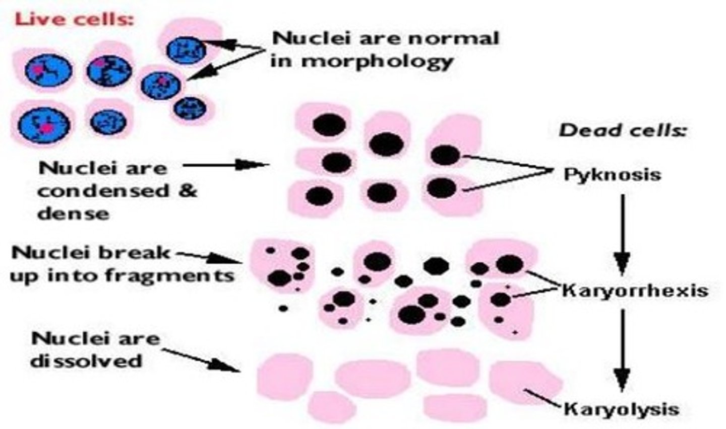 <p>1) Pyknosis = nuclei condensed</p><p>2) Karyorrhexis = nuclei fragmentation</p><p>3) Karyolysis = nuclei dissolved</p>
