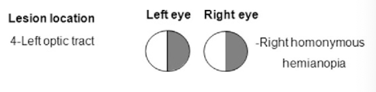 <p>optic tract lesion </p><p>complete right or left visual field deficit, right homonymous hemianopia</p>