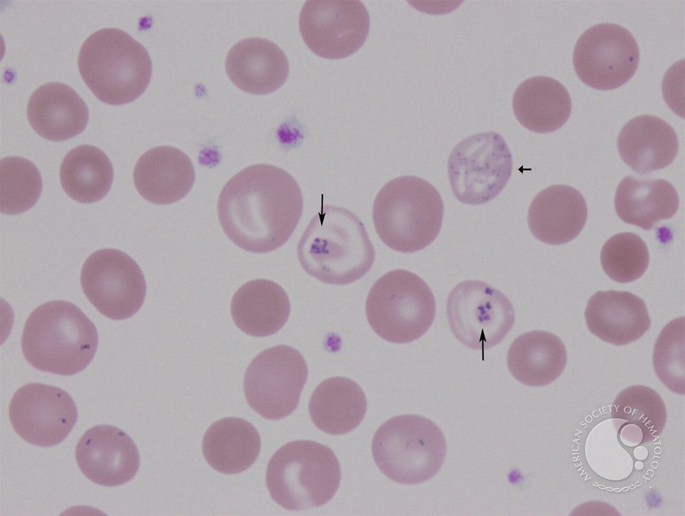 <p>what are siderocytes? (RBC inclusions)</p>