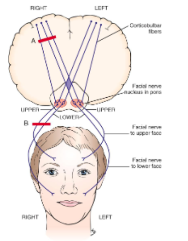 <ul><li><p>most cranial nerve nuclei receive projections from both cerebral hemispheres</p><ul><li><p>upper part of face = controlled by both</p></li><li><p>lower part of face = controlled by opposite side </p></li></ul></li><li><p>exceptions = cortical projections controlling tongue + lower part of face (which arise mainly from the opposite motor cortex)</p></li><li><p>isolated facial paralysis sometimes occurs after a stroke, with the upper part of the face spared since it is controlled by both cerebral hemispheres </p></li></ul><p></p>