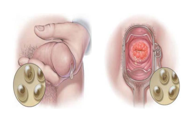 <p>Among the most common bacterial STIs in the world</p><ul><li><p>Passed by having unprotected oral, anal or vaginal sex</p></li></ul>