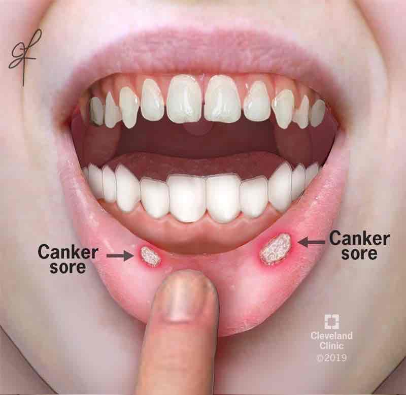 <p>Canker sores in the mouth</p>