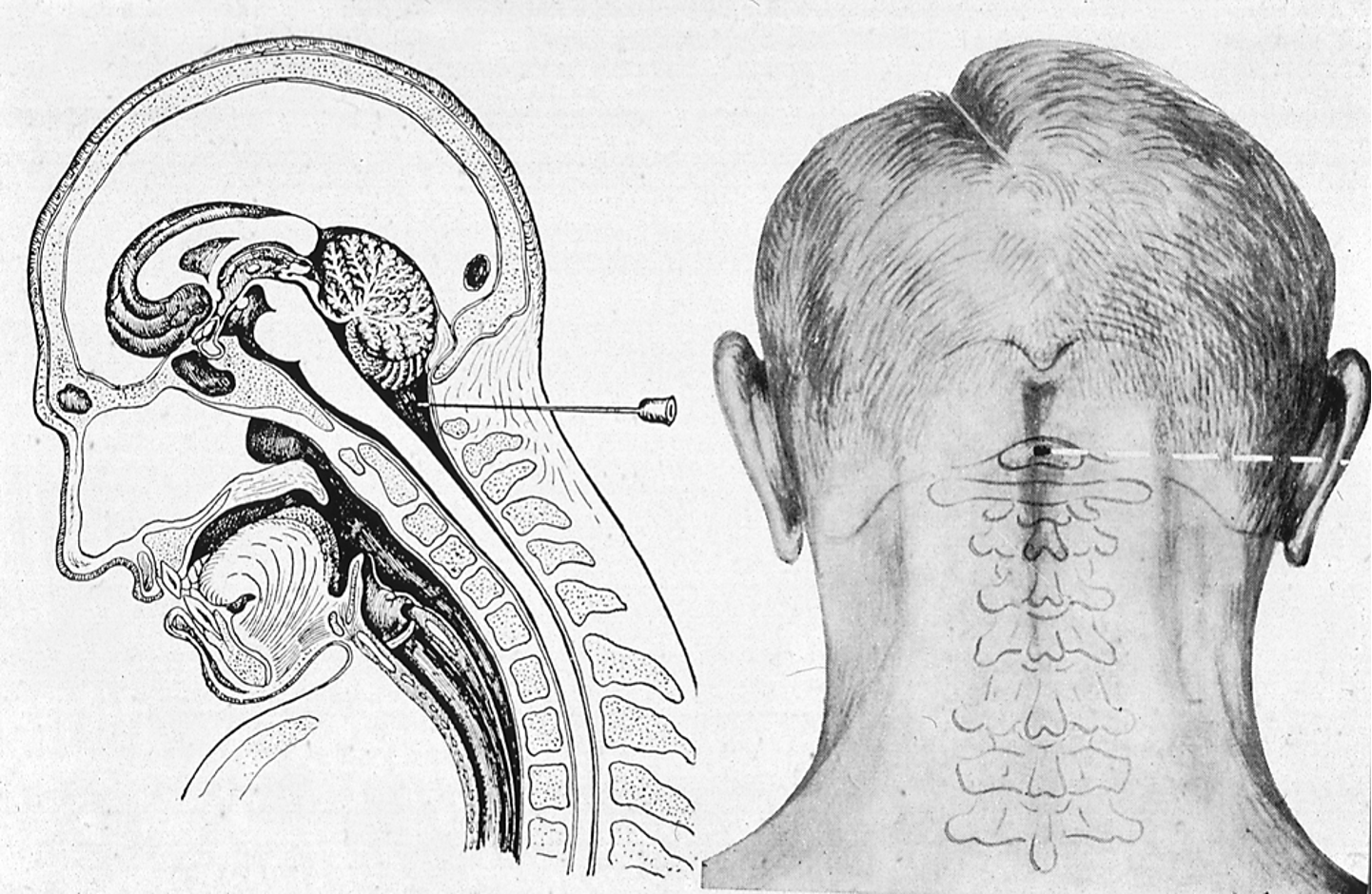<p>The cisterna magna is a large subarachnoid space situated between the __________ and the __________.</p>