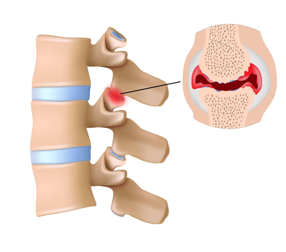 <p>Depression, shallow surface where bones articulate</p>
