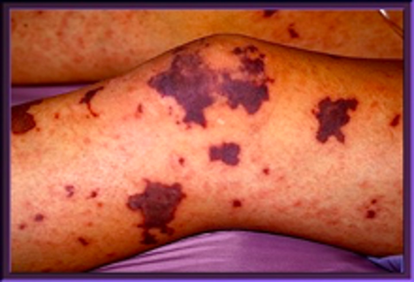 <p>- Rash: petechiae, palpable purpura, purpura fulminans</p><p>- Myalgias</p><p>- shock/DIC</p>