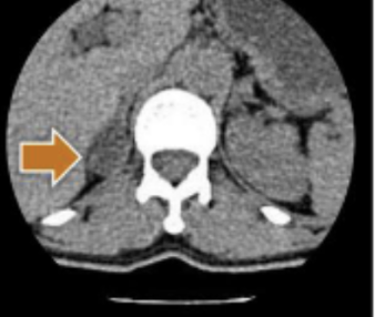 <p><span style="color: rgb(149, 106, 106)">CT adrenals </span><span style="color: #000000">scan 1 </span></p>