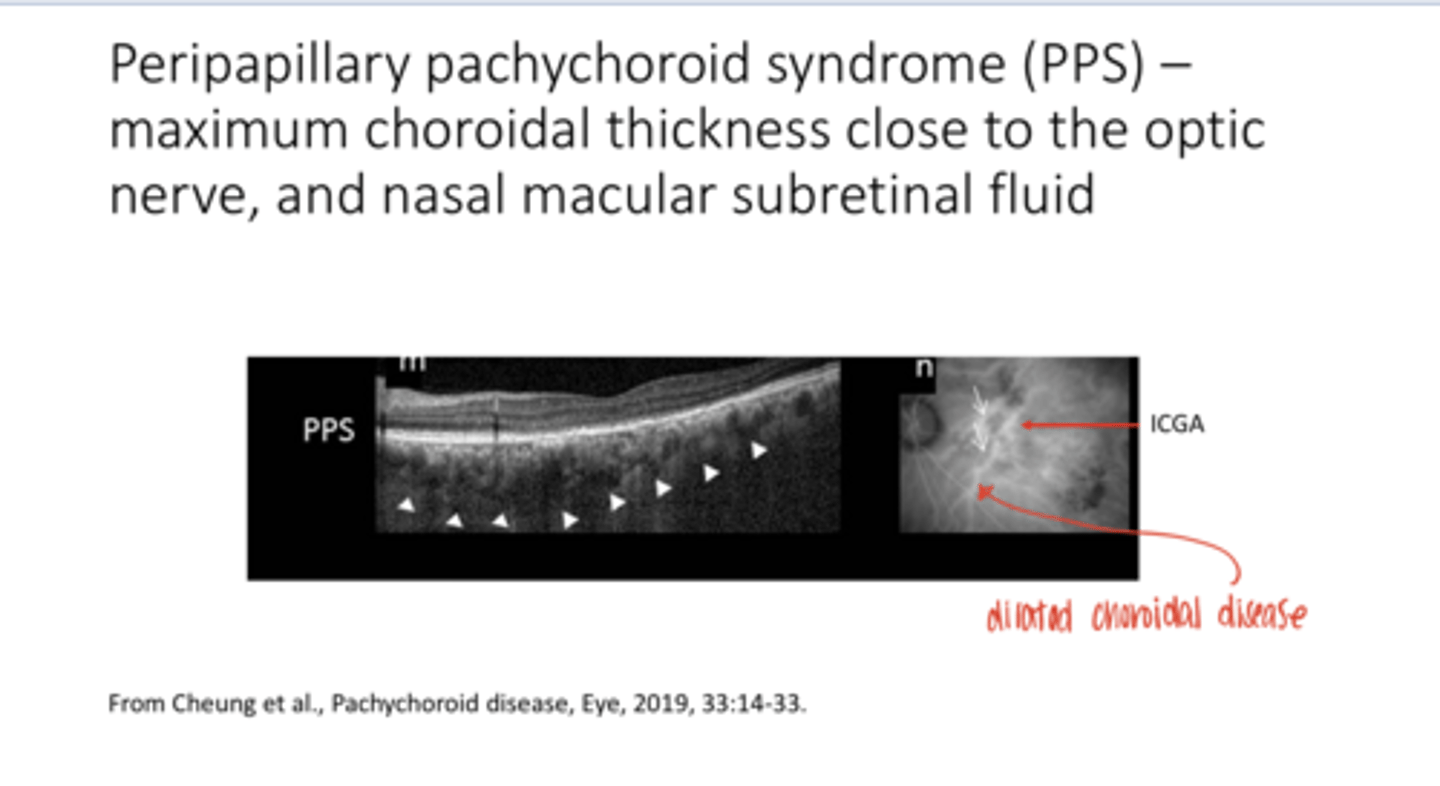 <p>Peripapillary Pachychoroid Syndrome (PPS) -- Maximum Choroidal Thickness Close to the Optic Nerve and Nasal Macular Subretinal Fluid (Pic)</p>