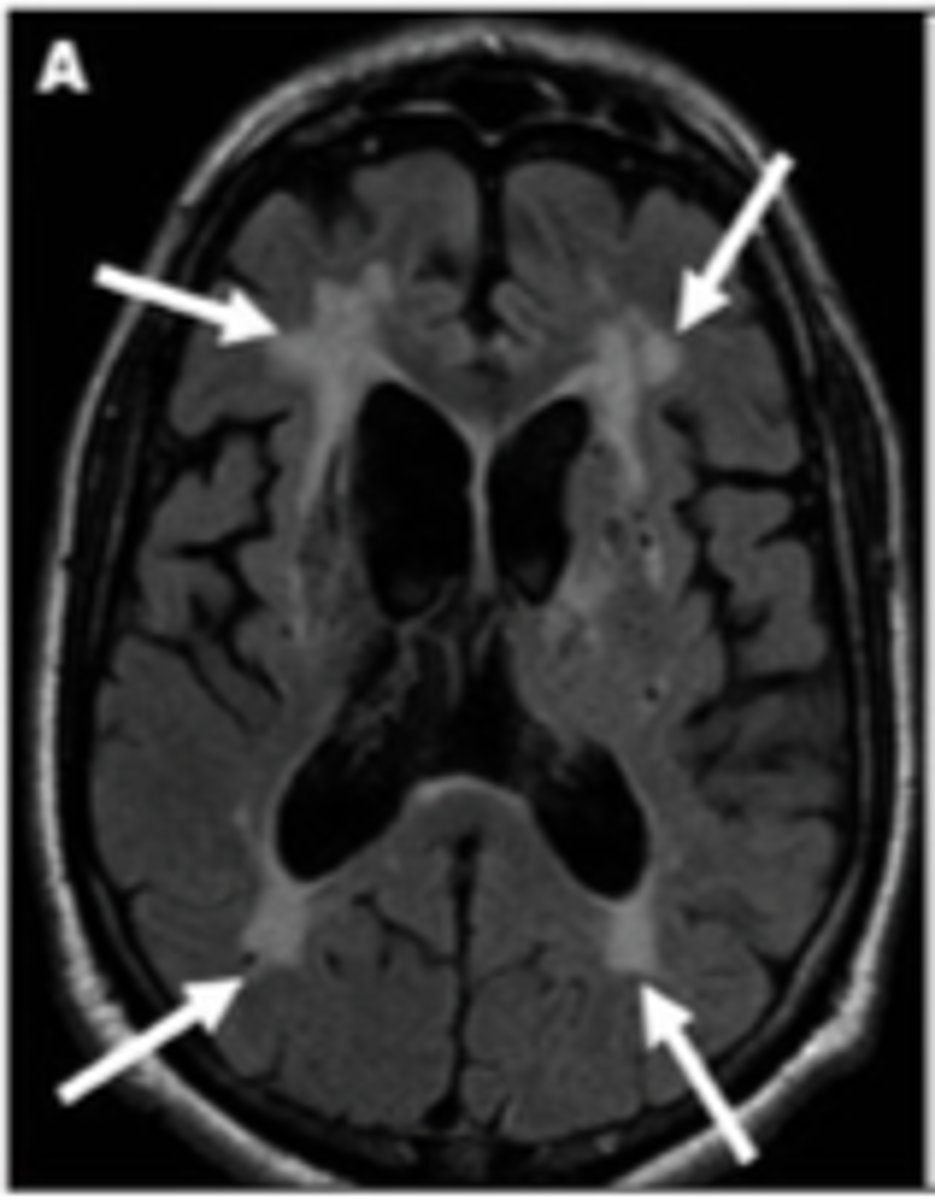 <p>Widespread damage from "mini strokes," caused by blockages in the brain's blood supply leading to widespread, diffuse damage and cognitive loss, may cause or exacerbate Alzheimer's</p>