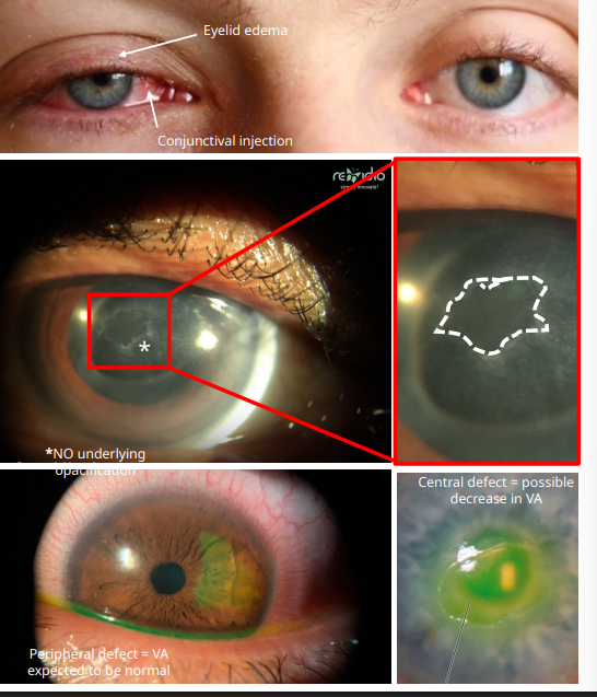 <ol><li><p>usually unilateral </p></li><li><p>INJURY</p></li><li><p>swollen eyelid w conj injection </p></li><li><p>SLE</p><ol><li><p><strong><u>corneal ep defect </u></strong></p><ol><li><p><strong><mark data-color="yellow" style="background-color: yellow; color: inherit;"><u>ABSCENCE of underlying opacification = NO infiltrate </u></mark></strong></p></li><li><p>meausre it </p></li></ol></li><li><p><u>Mild AC rxn </u></p></li></ol></li><li><p><strong><mark data-color="yellow" style="background-color: yellow; color: inherit;"><u>positive Na/Fl stainging </u></mark></strong></p></li></ol><p></p>