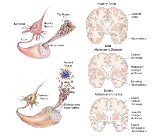 <ul><li><p>most common form of dementia</p></li><li><p>age-related disease</p></li></ul>