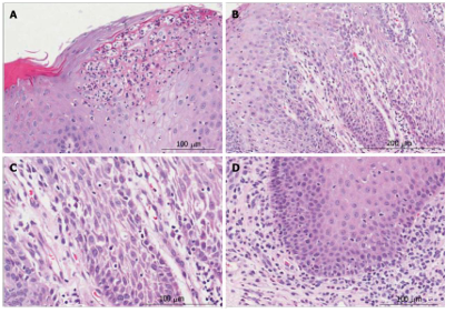 <p>-acanthosis, parakeratosis, inflammation in lamina propria</p><p>-neutrophils in spinous layer of epithelium = MUNRO abscess</p><p>-neutrophils are responsible for destruction of superficial portion of epithelium → atrophic, reddened mucosa</p>