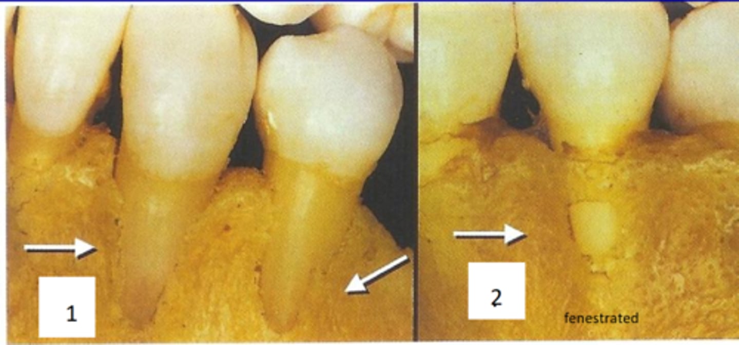 <p>loss of alveolar bone</p><p>oval shaped root exposure apical to CEJ</p>