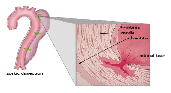 <p>What does this refer to</p><ul><li><p>Tear in the inner wall of the aorta (intima) causes blood to flow into the middle layer (media) and force the layers apart</p></li></ul><p></p>