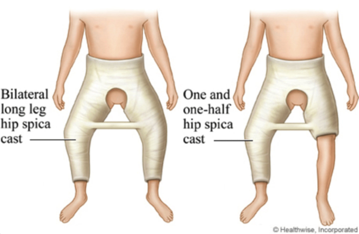 <p>encompassases abdomen, long cast on broken leg, short cast on other leg to stabilize child → often seen with femur fracture</p>