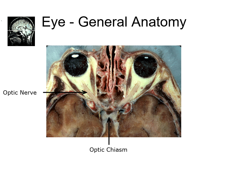 <p>optic nerve and optic chiasm </p>