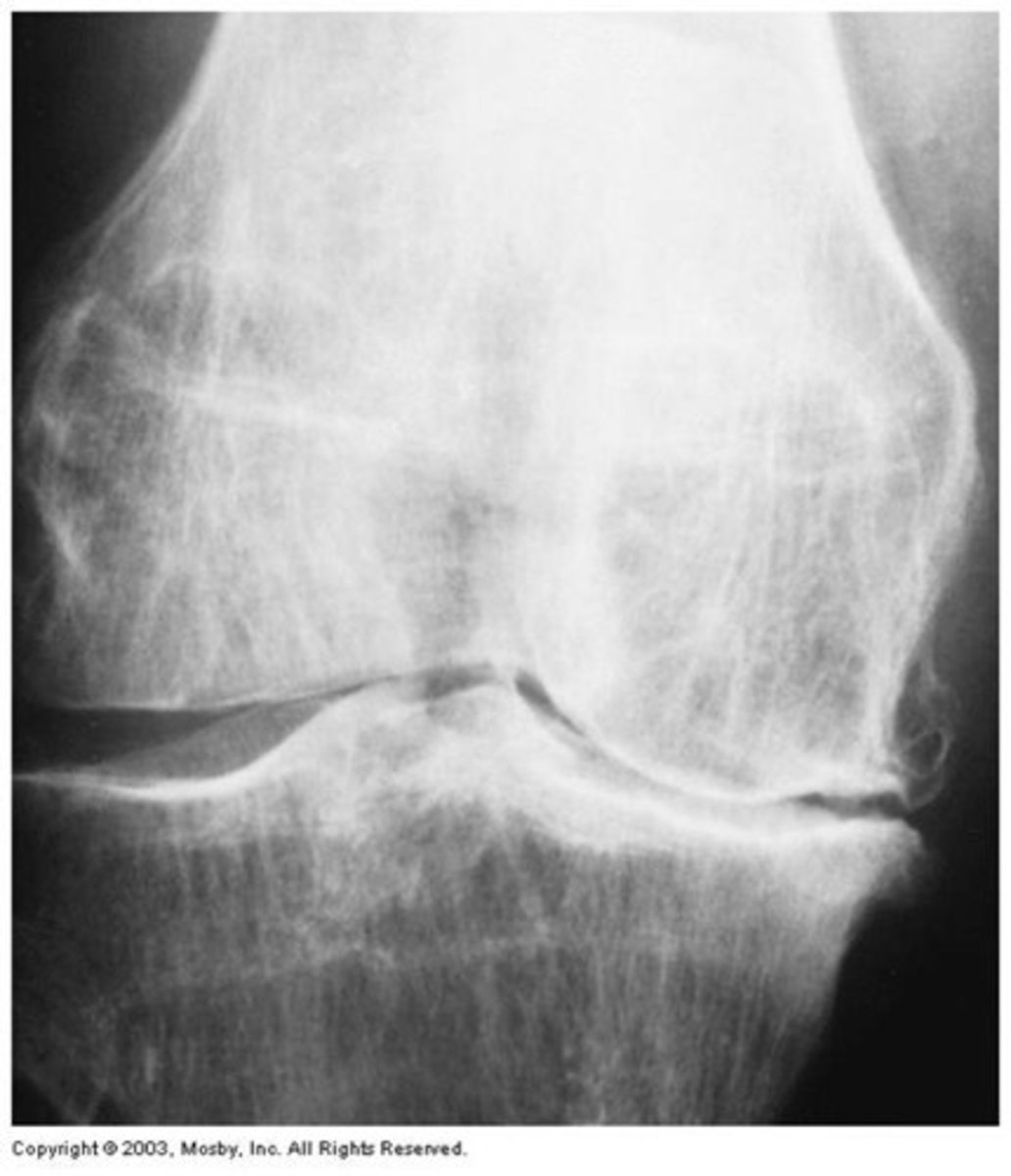 <p>osteoarthritis of knee</p><p>medial compartment (medial tibial plateau and medial femoral condyle) is more commonly involved!</p>