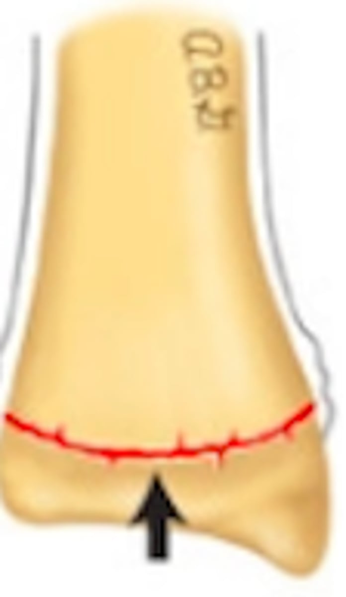 <p>Salter Harris grade?</p>