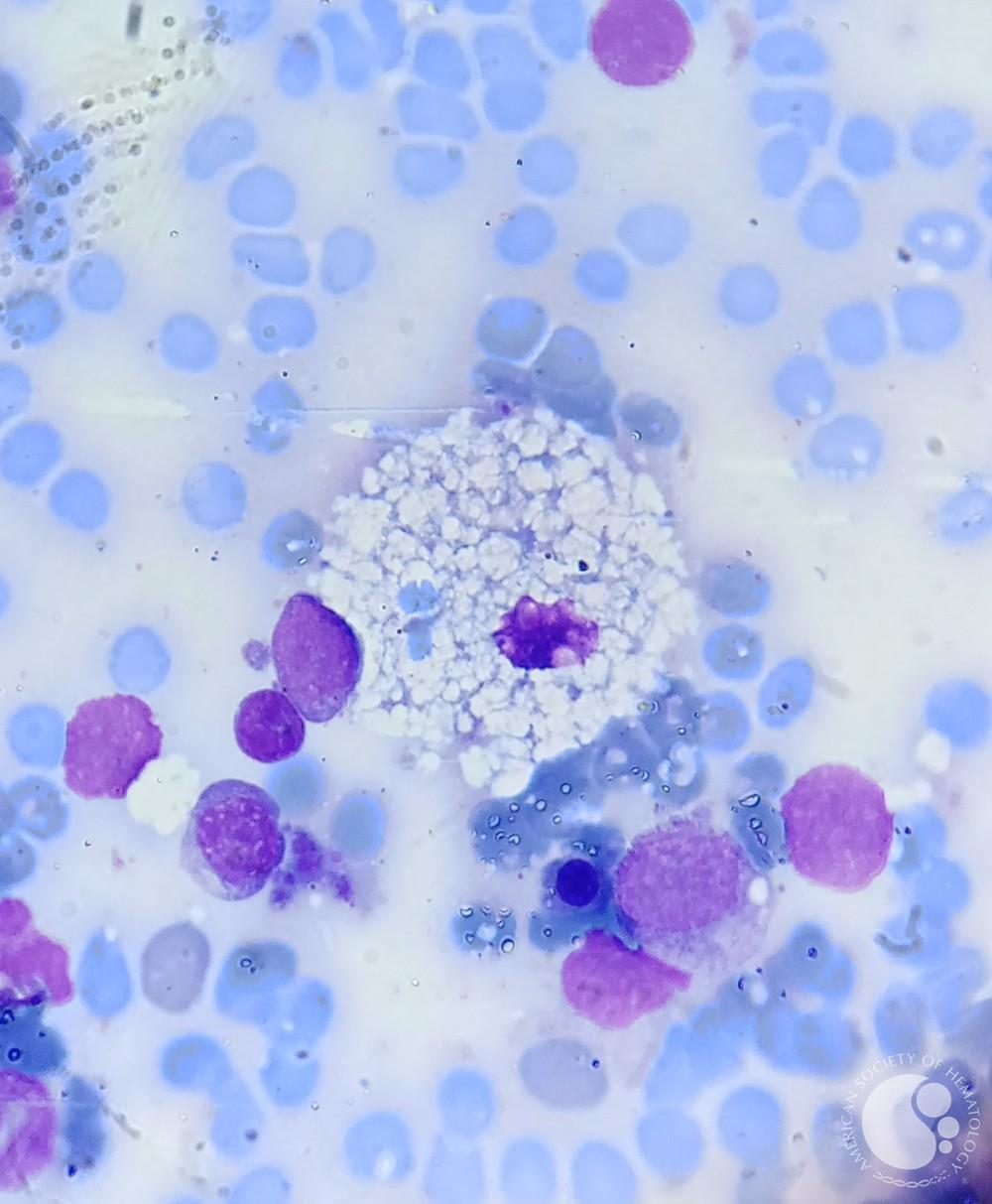 <p>What condition seen in Ashkenazid Jews is a lipid storage disorder of macrophages caused by a deficiency of <strong>sphingomyelinase</strong>?</p>